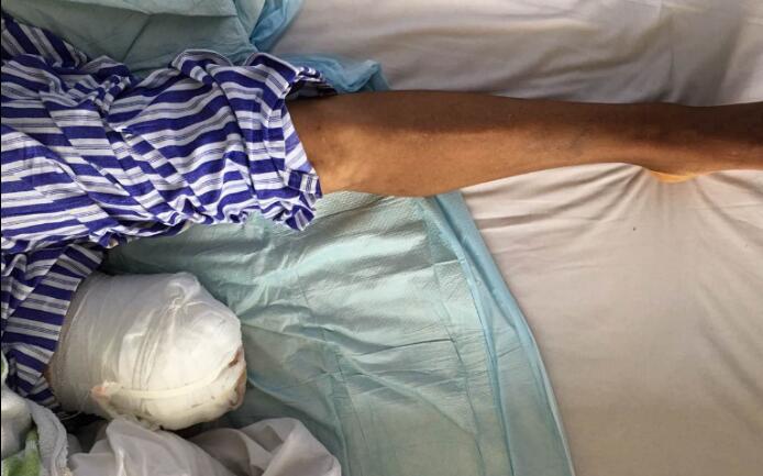 【保山安利醫(yī)院】濫用民間草藥，造成截肢后果