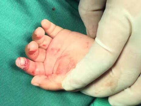 你相信嗎？兔子能把手指給咬斷了！