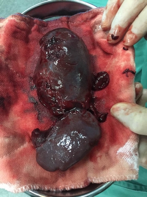 14歲男孩玩耍摔倒，脾臟破裂，險些喪命！