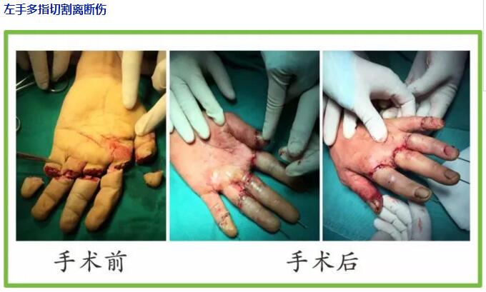 同樣斷指不同結(jié)局—斷指保存和康復指導