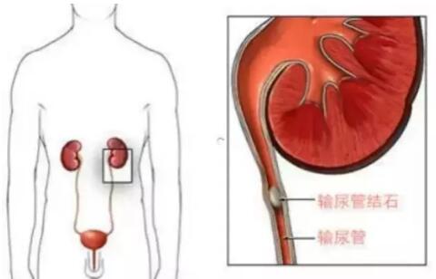 輸尿管結(jié)石，到底能不能保守治療？