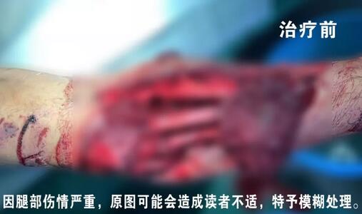 感謝安利醫(yī)院挽救了我的腿，沒(méi)有讓我落下殘疾……”