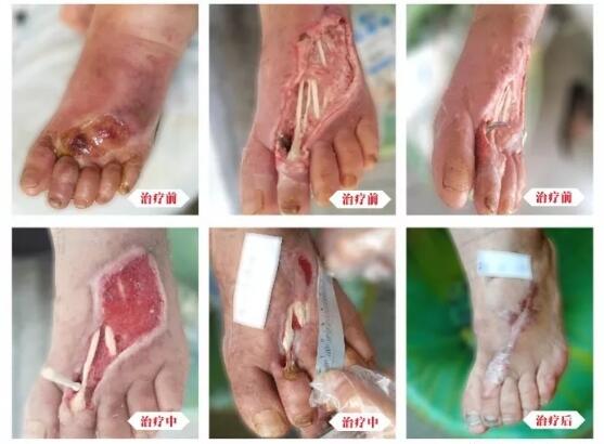 糖尿病并發(fā)癥有多可怕，及時(shí)治療糖尿病足避免截肢！