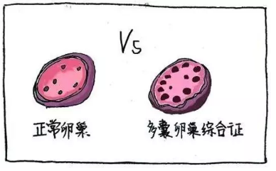 多囊卵巢綜合征與生酮飲食，您不知道的“減肥效果”