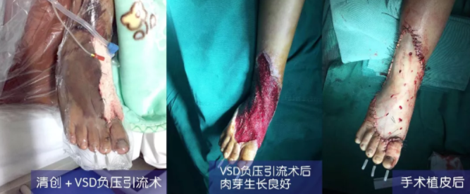 車禍猛如虎，救治如“華佗” ，手術(shù)＋康復(fù)，8歲小女孩車禍后日漸康復(fù)行走