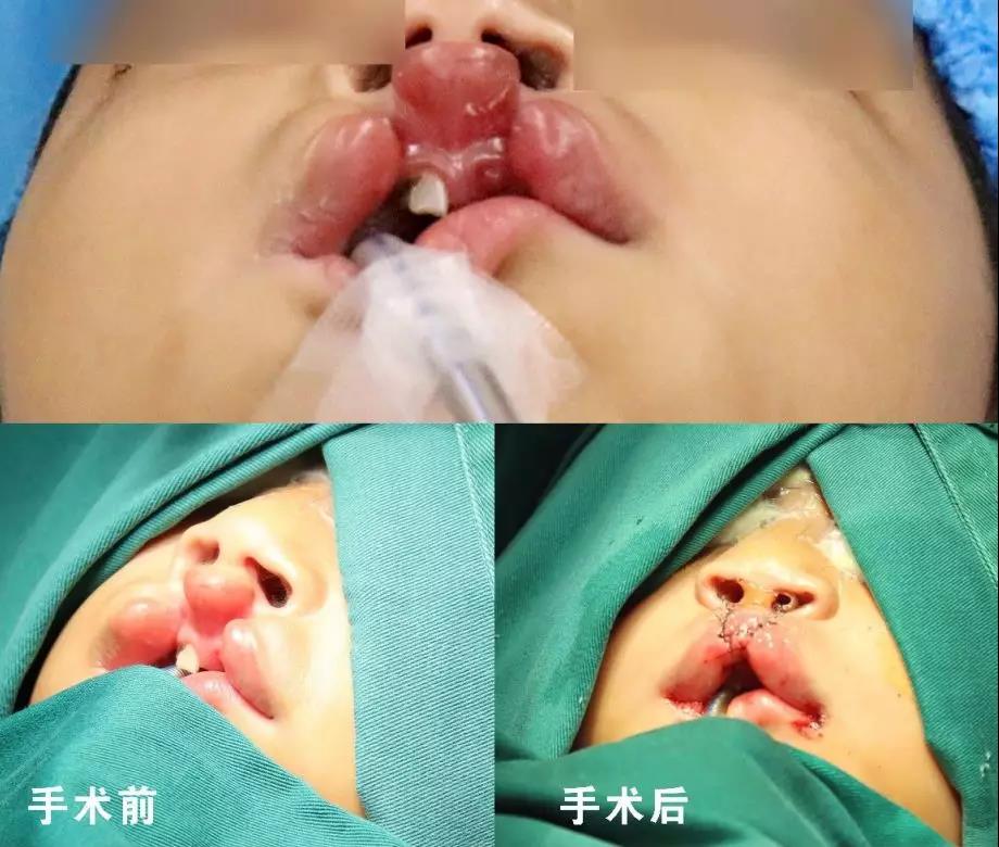 唇腭裂盡早治療消除孩子自卑心理，快樂(lè)成長(zhǎng)！