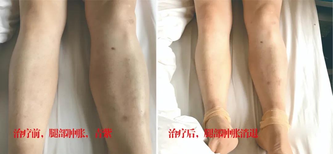 下肢靜脈血栓多年頑疾反復(fù)腫痛——疾病不容等待，早治療，早健康！