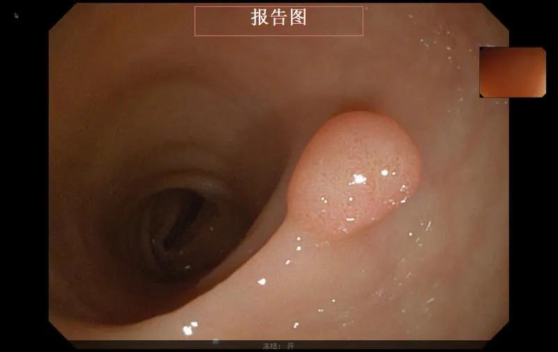 保山安利醫(yī)院成功開展內(nèi)鏡下消化道息肉高頻電切除術