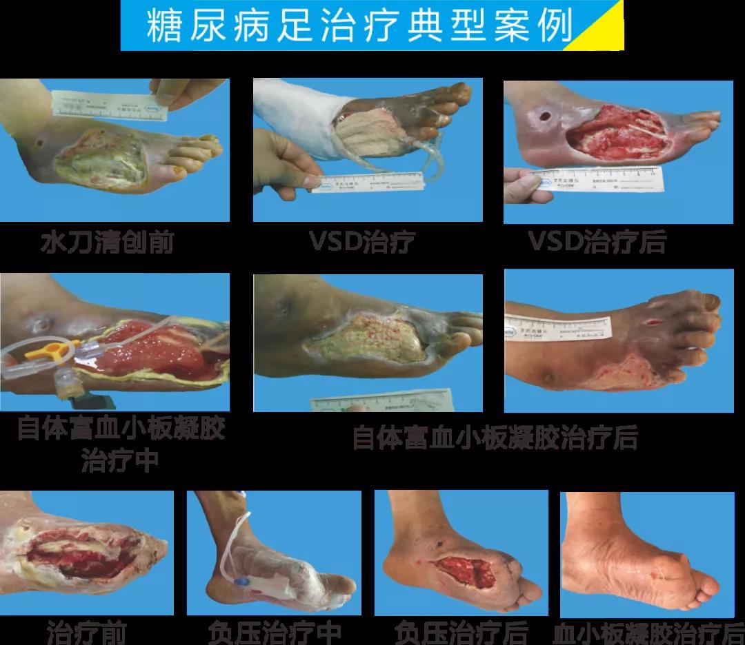 截肢、失明，甚至……，我們要做的是將糖尿病并發(fā)癥遏制在搖籃里！