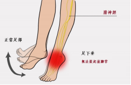 【保山安利醫(yī)院—健康科普】什么是足下垂！你了解嗎？