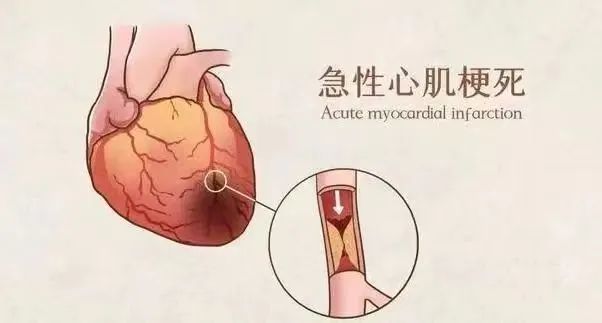【保山安利醫(yī)院】11月20日“心梗救治日” 時間就是心肌，時間就是生命！